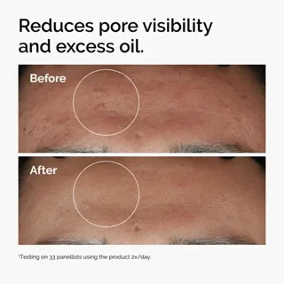نتیجه استفاده از نیاسینامید اوردینری